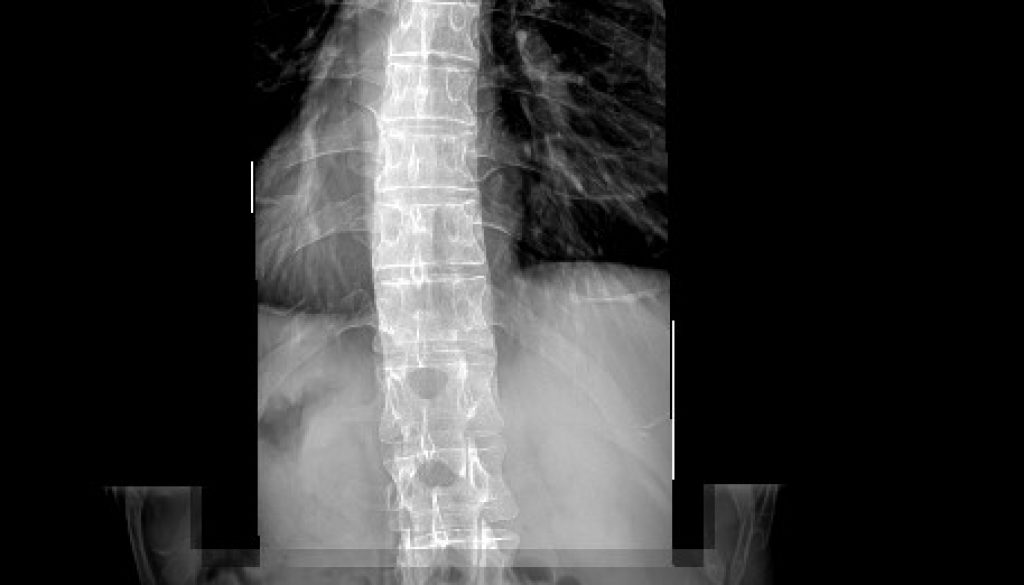 Full spine spinal x-rays