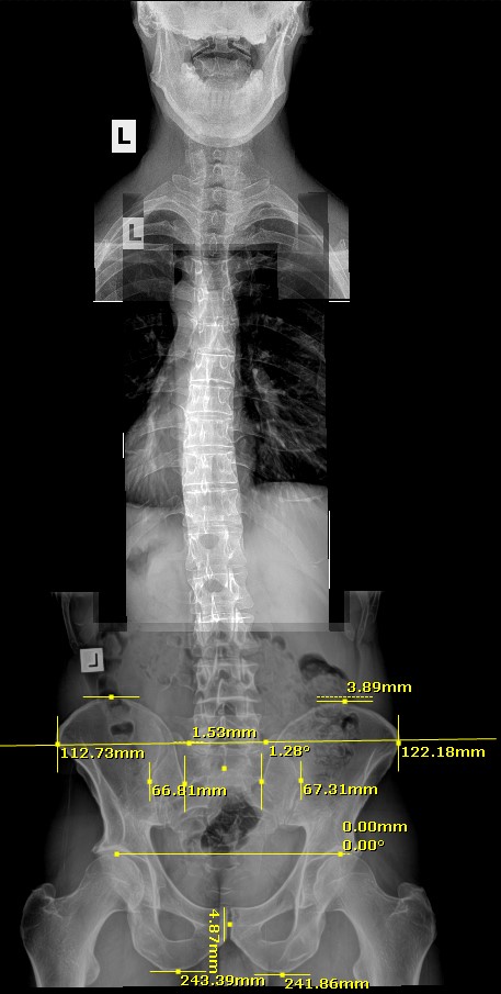 The use of x-ray in Gonstead Chiropractic