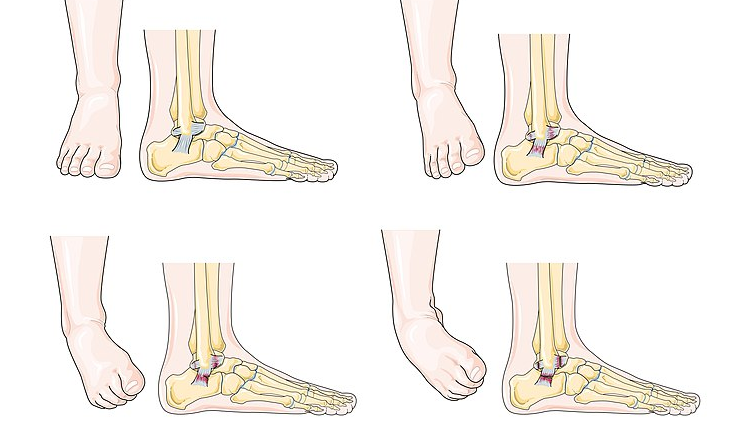 Ankle sprains – chronic and unresolved?