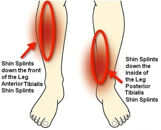 What are shin splints? (Medial tibial stress syndrome (MTSS)